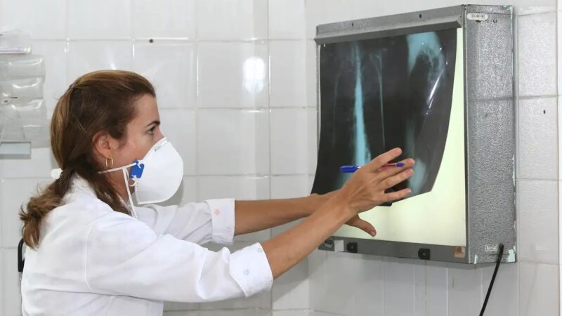 Pernambuco mantém alta de casos de tuberculose em 2025, com mais de 6 mil notificações